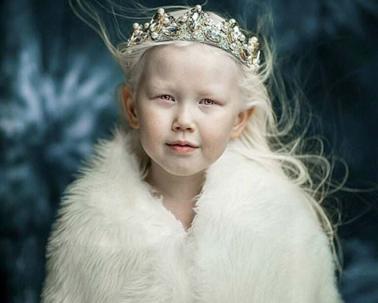 Masallardan Fırlamış Gibi Görünen Albino Hastası Küçük Kız: Güzeller Güzeli Nariyana
