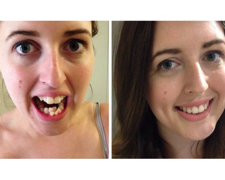 33 Karşılaştırmalı Fotoğrafla Diş Teli Takan İnsanların İnanılmaz Dönüşümleri