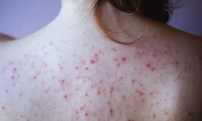 vucutta-igne-ucu-kadar-kirmizi-noktalar